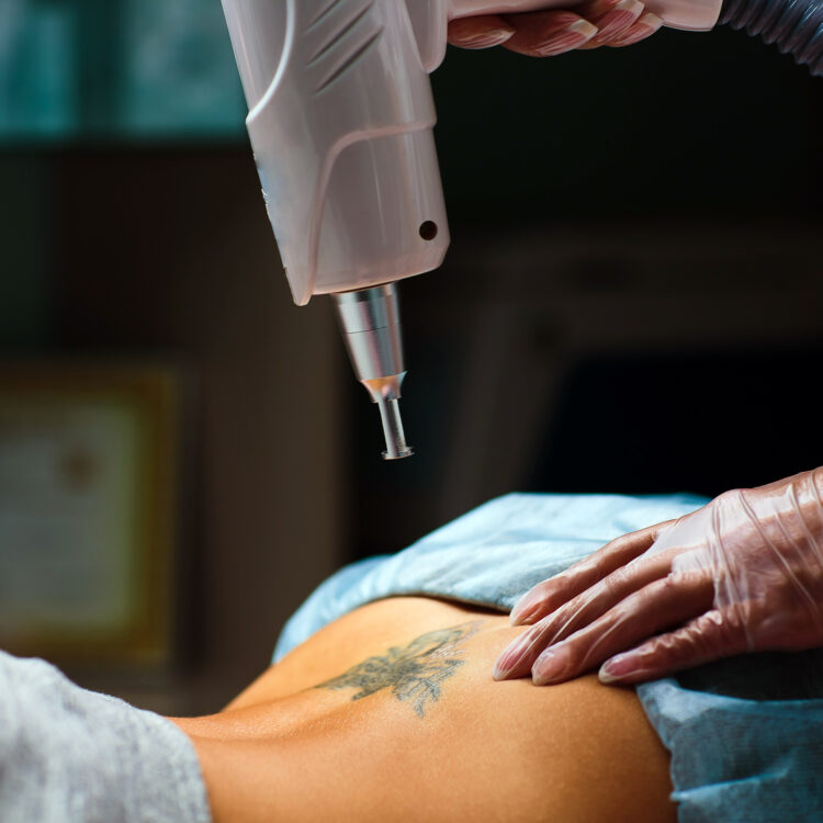 Laser Tattoo Removal Mayfair Advanced Aesthetics